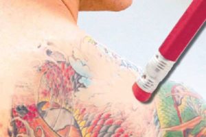 Tattoo-removal-eraser