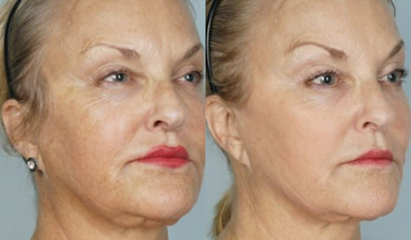 signs of aging cool peel results